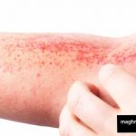 5 Atopic Dermatitis can Worsen Caution