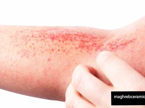 5 Atopic Dermatitis can Worsen Caution